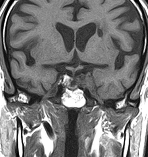 Meningiomas Cavernous Sinus And Olfactory Groove Image