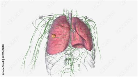 In Stage 2a Lung Cancer The Tumor Measures Between 4 Cm And 5 Cm And