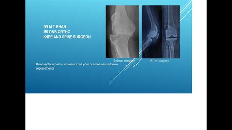 Knee Replacement Facts To Know Implants Recovery Time One Knee Or