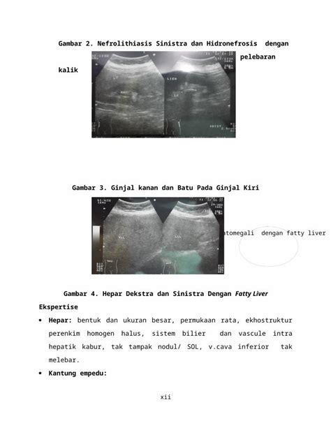 DOCX NEFROLITIASIS DAN HIDRONEFROSIS DOKUMEN TIPS