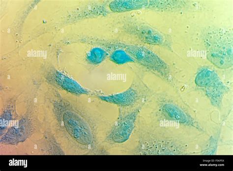 Cervical Cancer Cell Hi Res Stock Photography And Images Alamy