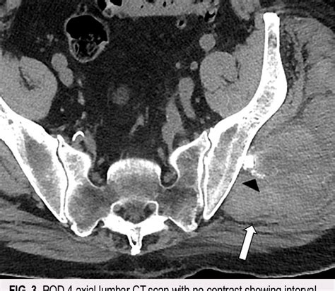 Figure 3 From Successful Coil Embolization Of A Ruptured Pseudoaneurysm