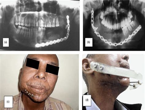 Plate-related complications: (a) screw loosening, (b) plate fracture ...