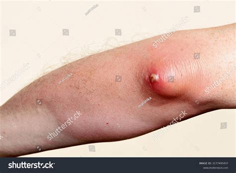 Olecranon Bursitis Abscess Elbow Inflammation Infection