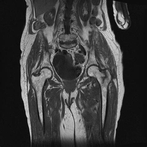 Hip Fracture Mri