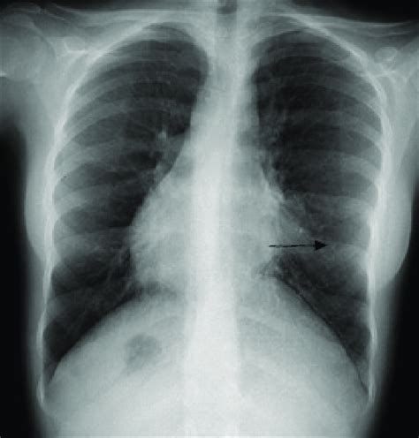 B Dextrocardia And Atelectasis Arrow On The Chest Radiograph Of The