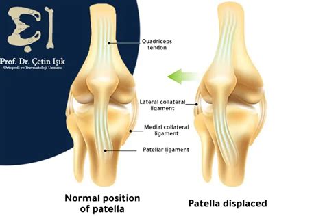 Learn about the process of installing knee braces - Dr. What's wrong ...