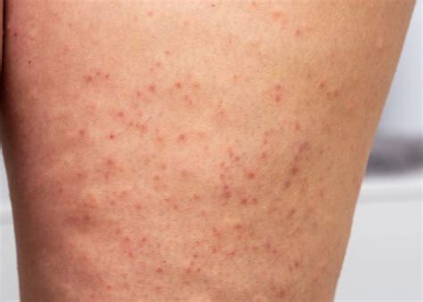 Skin Condition Keratosis Pilaris Skindevour