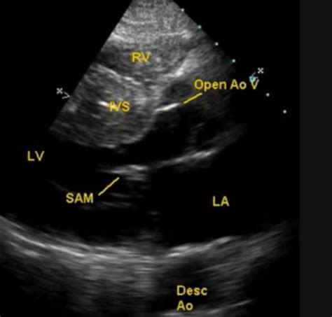 What Is Sam In The Heart All About Cardiovascular System And Disorders