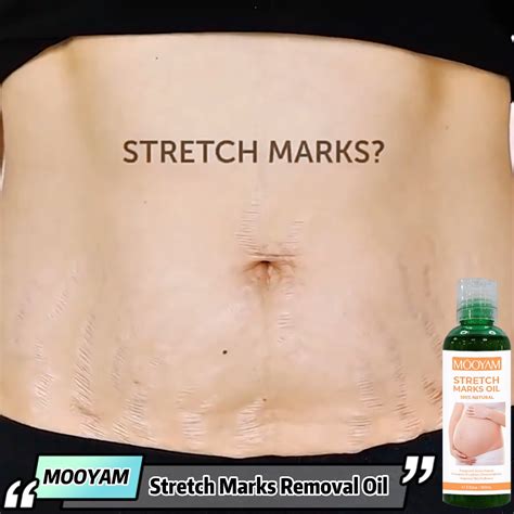 Private Label Stretch Marks Removal Essential Oil Effective Removal