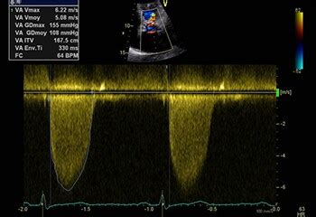 Cas clinique Comment expliquer lépaissisement et la calcification de