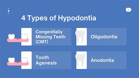 5 Causes of Hypodontia or Missing Teeth