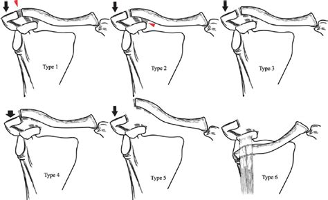 Rockwood Classification Of Acromioclavicular Joint, 44% OFF