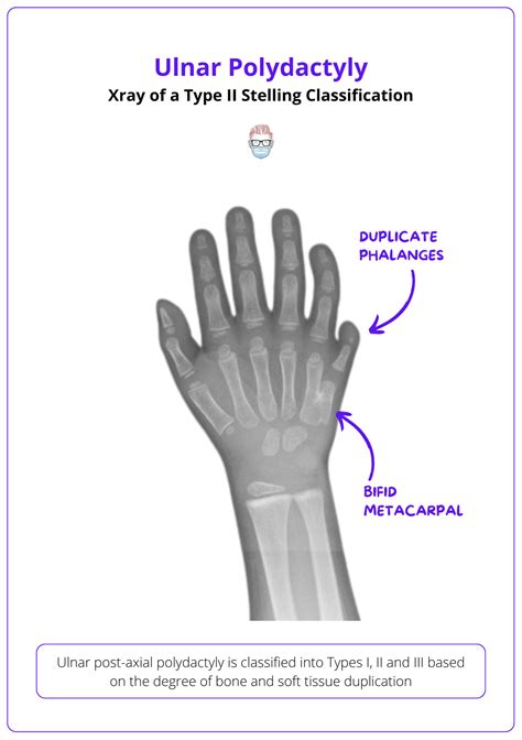 Polydactyly: Classification & Treatment