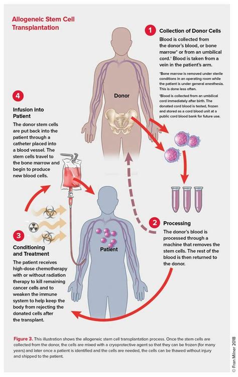 Physiotherapy in Stem Cell Transplantation - Physiopedia