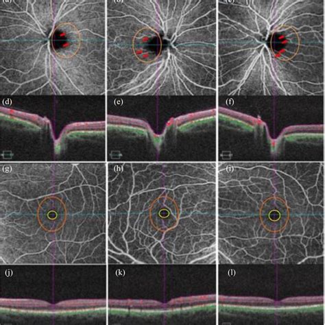 Retinal Vascular Plexuses Corresponding With A Histological Section Of