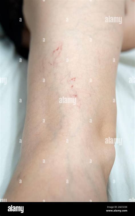 Removal Of Blood Vessels By Laser Vessel Disease Problem Cutout