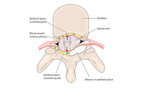 Epidural Abscess Archives - Spine Info