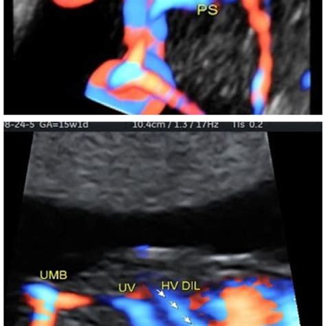 Power Doppler And D Power Doppler Showing Absence Of Normal Ductus