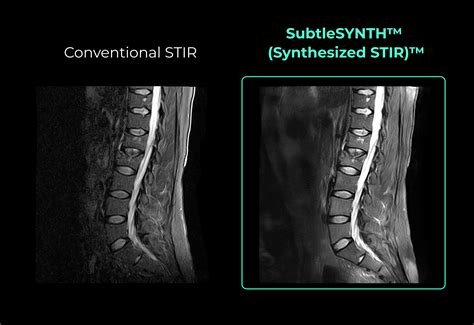 Subtle Medical - Deep Learning boosts healthcare. Faster, Safer, Smarter.