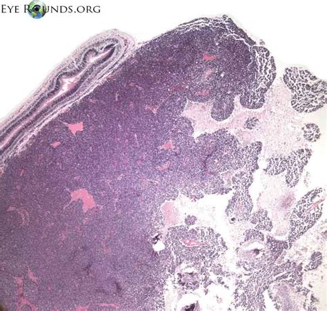 Atlas Entry Retinoblastoma