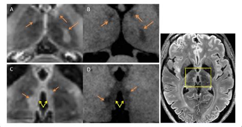 Thalamic Lesion Subtypes Examples Of Thalamic Lesions From Axial