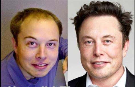 Elon musk before after | Saç EkimiSaç Ekimi