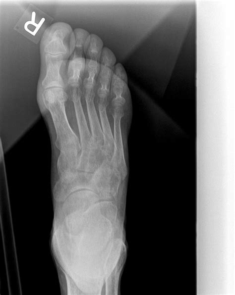 Digital Radiography Image Artifacts | Radiology | SUNY Upstate