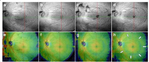 En Face Oct Images Show Progression Of Inner Retinal Defects After Ilm