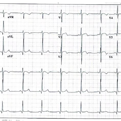 Electrocardiogram Showing Narrow Complex Tachycardia With Atrial