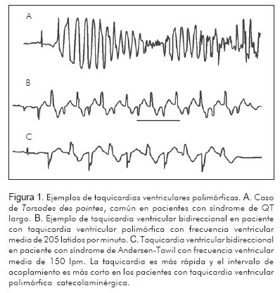 Taquicardia Ventricular Polimórfica