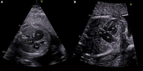 Different Phenotypes Of Left Ventricular Hypoplasia In The Fetus A Download Scientific