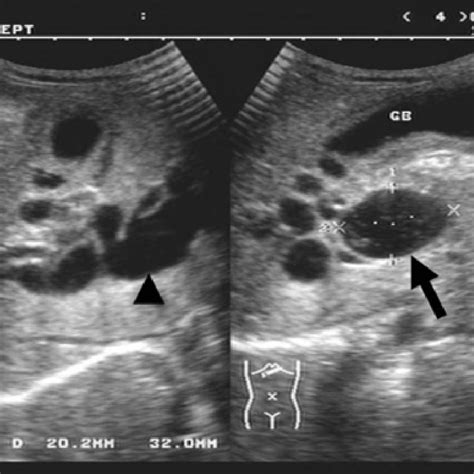 Cystic Duct Common Bile Duct