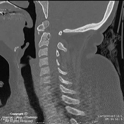 Neuroradiology On the Net: Os Odontoideum