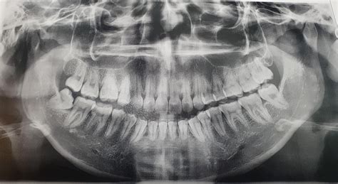 wisdom tooth erupted after 1 year of mewing but it's impacted. what's