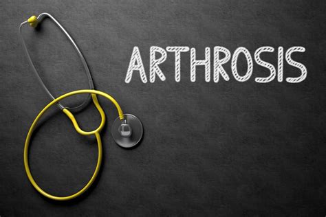 10 Lifestyle Changes for Managing Arthrosis Symptoms - Facty Health