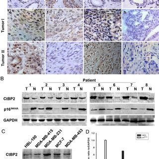 Expression Of CtBP2 And P16 INK4A In Human Breast Cancer A