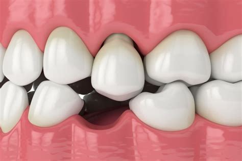 3 Reasons That A Missing Tooth Needs To Be Replaced Northside Dental Care Pc Peabody