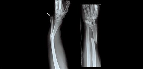 Upper Limb Fractures – Trinay Orthopedic