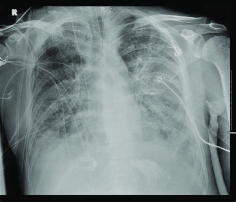 Chest radiograph, hospital day 28. Extensive bilateral diffuse airspace... | Download Scientific ...