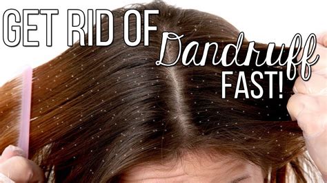 How To Get Rid Of Dandruff Fast Only 2 Ingredients Highly Effective