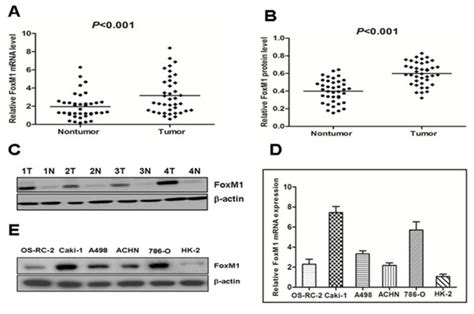 The Expression Of Foxm1 Mrna And Protein In The Human Ccrcc Surgical