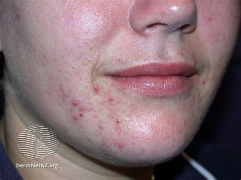 Tetracycline Acne Before And After