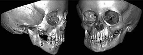 Corpus and symphysis fracture due to fall at age 3. | Download ...