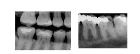 (a) Bitewing X-ray. (b) Periapical X-ray | Download Scientific Diagram