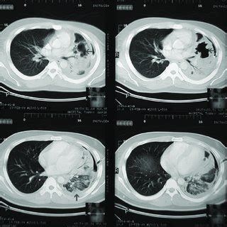 High Resolution Hrct Scan Of The Chest Showing Areas Of Cavitation In