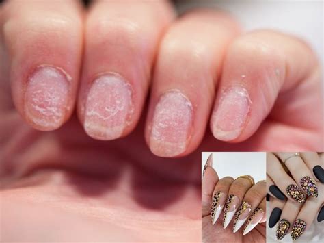 How To Fix Peeling Nails