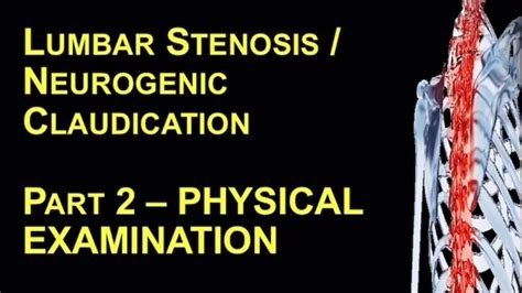 Lumbar Stenosis Neurogenic Claudication Part 2 Physical Examination Youtube