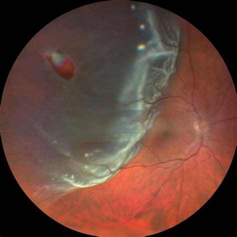 Retinal Tear And Retinal Detachment Surgery In Rhode Island