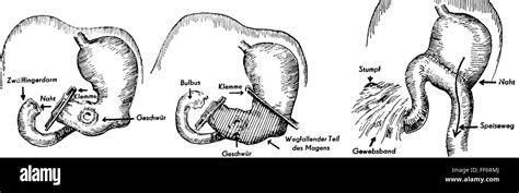 medicine, surgery, phases of gastric resection after Billroth II Stock ...